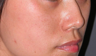 cheek implants surgery after photo patient